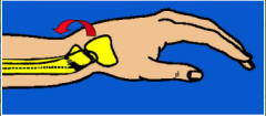 Fr. epifiză distală radius – cădere pe mână în hiperextensie – cu deplasare longitudinală, posterioară, laterală; Aspectul mâinii în “dos de furculiţă”