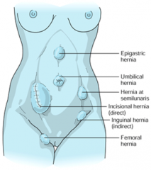 congenital/acquired
inguinal/umbilical/epigastric
external hernia= defect in the abdominal wall
internal hernia= defect through internal opening