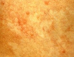 an abnormality of the skin in which the blood vessels, in a well demarcated patch, are persistently vasoconstricted, producing an area of cutaneous blanching.

Disorders of pigmentation must be distinguished.