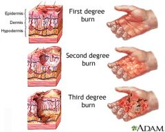 A type of injury to flesh or skin caused by heat, electricity, chemicals, friction, or radiation.