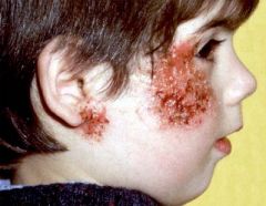 Impetigo is an infection of the skin classically caused by staph aureus.

The primary lesion is a thin walled vesicle that breaks easily. There is lateral extension of the superficial lesion with, typically, a honey colored crust at the edge.