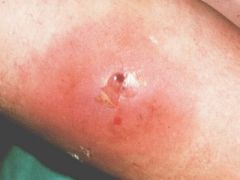an inflammatory nodule evolving into a pustule which then becomes necrotic, healing with a scar. It is caused by Staphylococcus aureus. Lesions may be single or multiple.