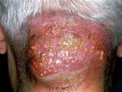 A necrotizing infection of skin and subcutaneous tissue composed of a group of furuncles (boils).