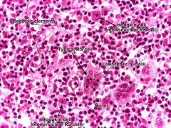 Reed-Sternberg cell

surrounded by dense inflammatory infiltrate