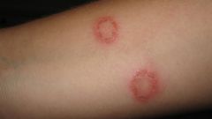 Causes a scaly, crusted rash that may appear as round, red patches on the skin.Other symptoms and signs of ringworm include patches of hair loss or scaling on the scalp, itching, and blister-like lesions.


 
