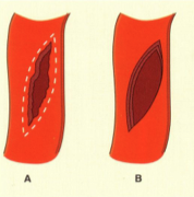 Her ser du trinn A og B i reparasjon av en type karskade. Hva gjøres på trinn C og D?