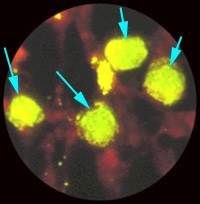 Immunofluorescence (antibody stain)


*green apple bodies w/i cell



tx: azithromycine, doxycycline