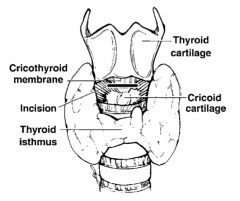 Cricothyroidotomy, aka "surgical airway":
 
Incise the cricothyroid membrane between the cricoid cartilage inferiorly and the thyroid cartilage superiorly and place an endotracheal or tracheostomy tube into the trachea