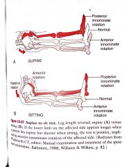 -measures functional leg length


-determines if there is a posteriorly or anteriorly rotated innominate based on apparent leg length differences


-if LE longer in supine but shorter in sitting = (+) anterior innominate rotation on affected side
...