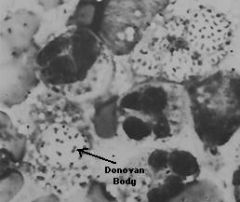 intracellular inclusions called donovan bodies


 


(w/i macriphageo