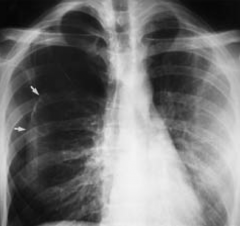 Loss of lung markings 
 
(Figure shows a right-sided pneumothorax; arrows point out edge of lung-air interface)