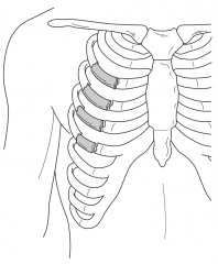 Two separate fractures in three or more consecutive ribs