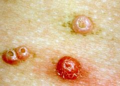 caused by a member of the pox virus family, is a cutaneous eruption consisting of one or more, 1 to 3 mm. diameter, flesh colored papules with a central umbilication.