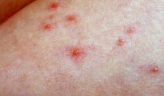 Varicella is caused by Herpesvirus varicellae, also known as the Varicella zoster virus. 


Typical varicella lesions are clear, tense vesicles, surrounded by an erythematous halo, that erupt over the skin surface, after a 9 to 21 day incubatio...