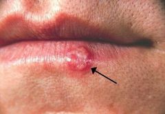 An outbreak typically causes small blisters or sores on or around the mouth. The sores typically heal within 2–3 weeks