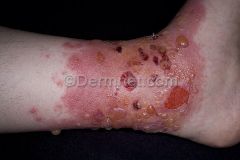 an allergic contact dermatitis caused by the Rhus (Toxicodendron) genus of plants. Members of this genus are poison ivy, poison oak, and poison sumac.