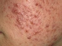 a chronic skin condition characterized by areas of blackheads, whiteheads, pimples, greasy skin, and possibly scarring.