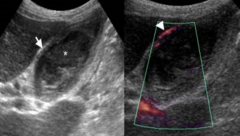 On the picture on the right, the arrow is pointing to hypervascularity of which artery?