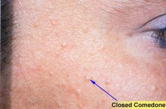 look like bumps on the skin's surface. Sometimes closed comedones have an obvious white head. In other cases, they are skin colored.
