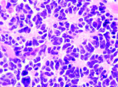What kind of structure in what tumor?
What type is associated with MYC gene?