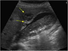The top yellow arrow is pointing to a localized fluid collection within the gallbladder fossa caused by the gallbladder bursting open. This condition is known as what?