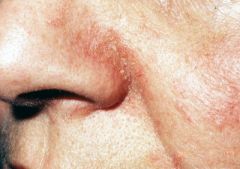 chronic eruption with erythema and scaling, involving typically the scalp, external ear canals, eyebrows, central face and the central anterior chest.