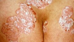 A condition in which skin cells build up and form scales and itchy, dry patches