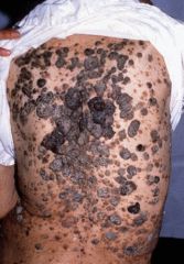 raised, skin-colored to dark brown/black lesions. They are well demarcated.

Clinically, the surface is rough.
