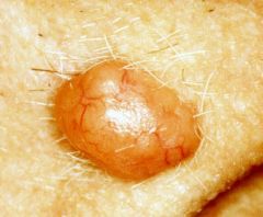 a well demarcated, translucent papular or nodule with evident telangiectasia. There may be central ulceration, the so-called "rodent ulcer".
