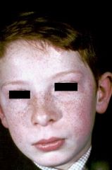 flat brown lesion. The term lentigo usually does not refer to large, congenital lesions