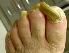 May be caused by trauma or peripheral vascular disease, but most often secondary to self-neglect and failure to cut the nails for extended periods of time. This condition is most commonly seen in the elderly.
