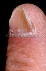 Spoon nails is a nail disease that can be a sign of hypochromic anemia, especially iron-deficiency anemia.