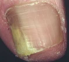 a fungal infection of the nail. It is the most common disease of the nails and constitutes about half of all nail abnormalities.