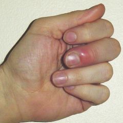 a nail disease that is an often-tender bacterial or fungal infection of the hand or foot where the nail and skin meet at the side or the base of a finger or toenail. 