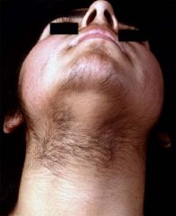 an increase of terminal (adult) hairs in androgen dependent areas such as the groin, axilla, nipple, and face. There is wide variation in normal hair growth.