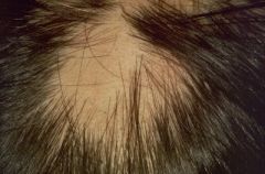 most commonly seen as well defined round patches of hair loss on the scalp. It may very occasionally become generalised.