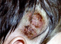 a fungal infection of the scalp with invasion of the hair shafts by a dermatophyte. Dermatophytes causing tinea capitis include Microsporum canis, M. audouinii, Trichophyton tonsurans and, less commonly, other organisms.