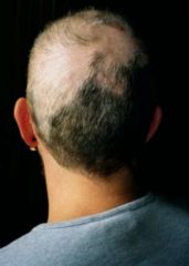 an impulse disorder characterized by the compulsive urge to pull out one's hair, leading to noticeable hair loss and balding, distress, and social or functional impairment.