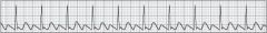 A 44-year-old man presents with the rhythm shown below. He complains of nausea, but denies vomiting. He is conscious and alert with a BP of 122/62 mm Hg, a pulse rate of 98 beats/min, and respirations of 16 breaths/min and unlabored. Treatment for...