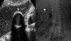 This patient's gallbladder's walls are calcified, causing shadowing. This condition is known as what?