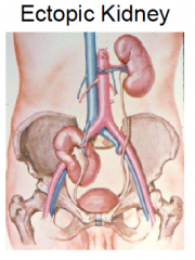 - accessory renal arteries
- ectopic kidneys (if it doesn't asend, it will not rotate medially)
- Fused kidneys (can't ascend past the SMA)