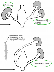 - bifid ureter (bud splits before entering mass) 

- supernumerary kidney (bud splits before entering mass with large distance in between buds) 

- crossed ectopian

- Renal Agenesis (failure of the bud and mass to interact)