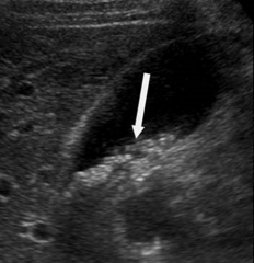 The arrow is pointing to very tiny gallstones in this gallbladder. These gallstones are not producing shadowing, meaning they are probably less than ____ in size.