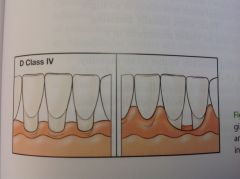 recession shows loss of hard (bone) and soft tissues around the entire tooth with open interdental areas.