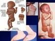 1. Trisomy 18 - lethal aneuploidy in which nearly all patients born with this condition die in the first two years of life


2. rocker-bottom feet, clenched fists, overlapping digits, cardiac defects like TOF and VSD, omphalocele, and neural tub...