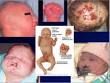 1. Trisomy 13- lethal aneuploidy in which a child inherits three copies of chromosome 13. Most will die within 1 year.


2. holoprosencephaly, cleft lip and palate, cystic hygroma, single nostril, or absent nose, omphalocele, cardiac defects lik...