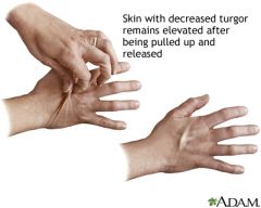 Is the test for hydration status performed by lifting the skin on the back of the hands