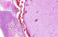 Brain
- Dilated spaces between meninges (normally very narrow) (Pia mater <--> arachnoid)
- Dilated vessels + neutrophils around 
- Sharp edge from inflamm --> No brain parenchyma infiltrate

Etiology?
Ways of spread of bacteria?
Grossly?