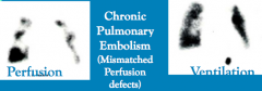 Shows a matched ventilation and perfusion defect in the right mid-lung, but several defects on perfusion imaging that are not matched with defects on ventilation (ie, unmatched perfusion defects), findings that are highly suspicious for *chronic p...