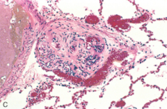 Plexiform lesion in small vessel in Group 1 Pulmonary Arterial HTN (PAH)
